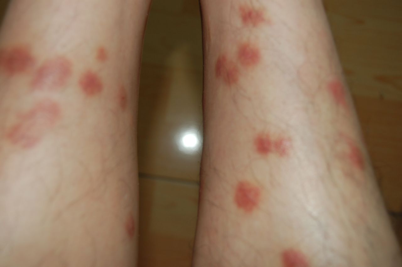 跳蚤引发的最常见的疾病是跳蚤过敏性皮炎和跳蚤叮咬性皮炎,被寄生的