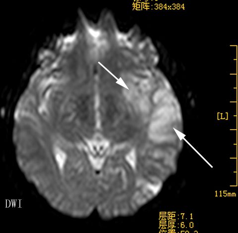 大腦前動脈綜合症