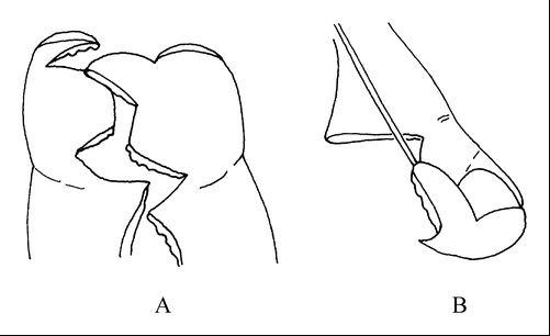 A.手術切口設計；B.指端皮瓣修復指甲緣