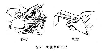 骶恥外徑