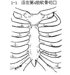 心包切開引流術