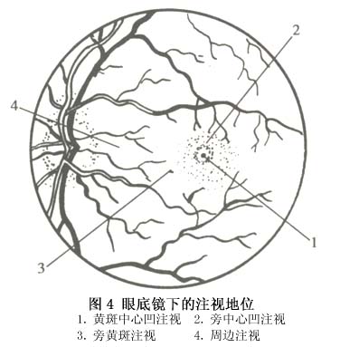 弱視眼的擁擠現象