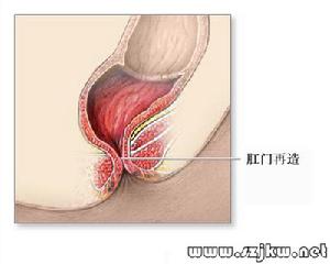 先天性直腸肛門發育畸形