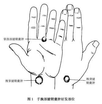 手腕部米粒大小硬如軟骨的包塊