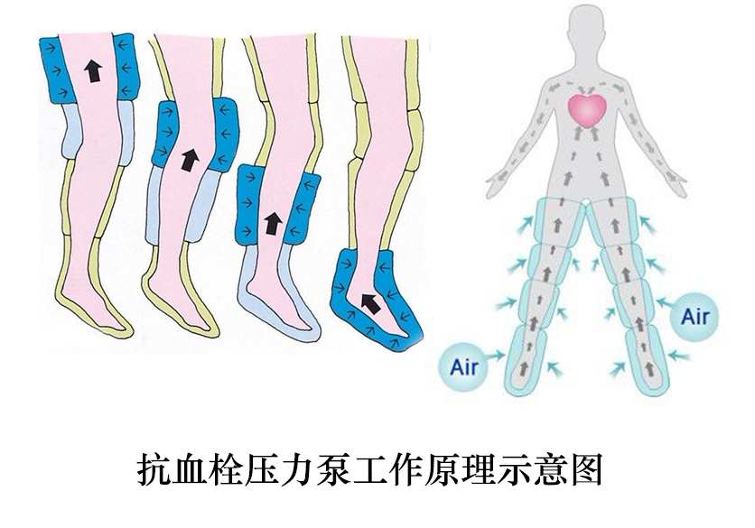 抗血栓壓力泵_示意圖