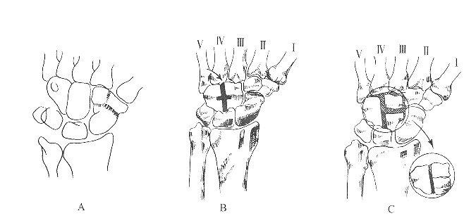 圖2  腕骨局部融合術