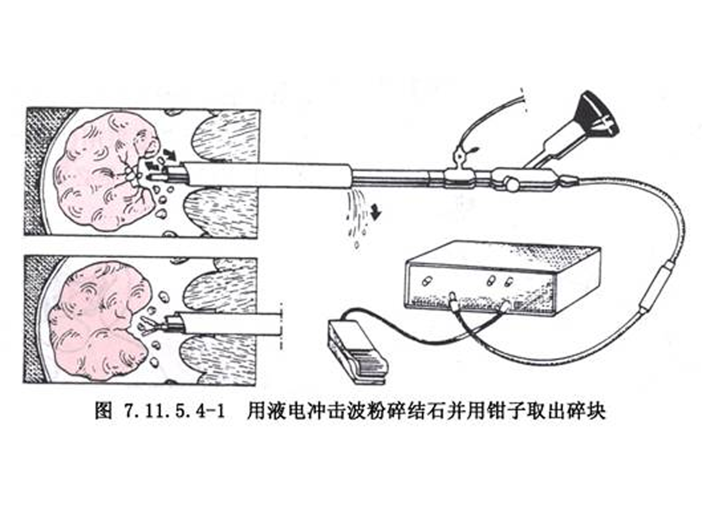 液電碎石術