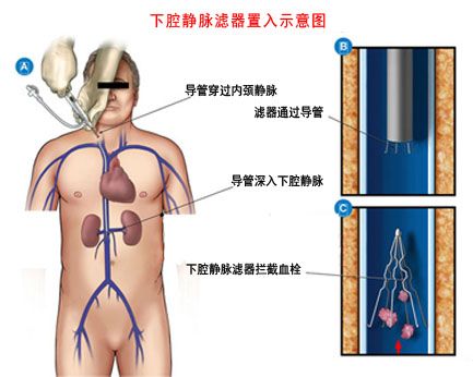 經皮放置靜脈濾器