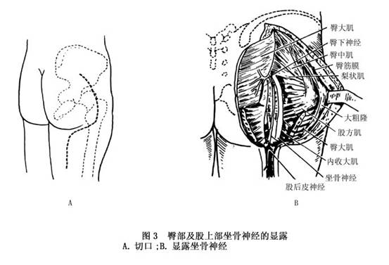 大腿以下或膝以下肌肉癱瘓