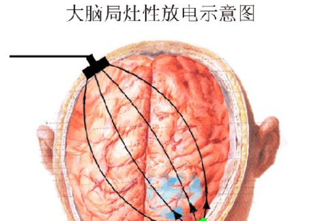 大腦異常放電