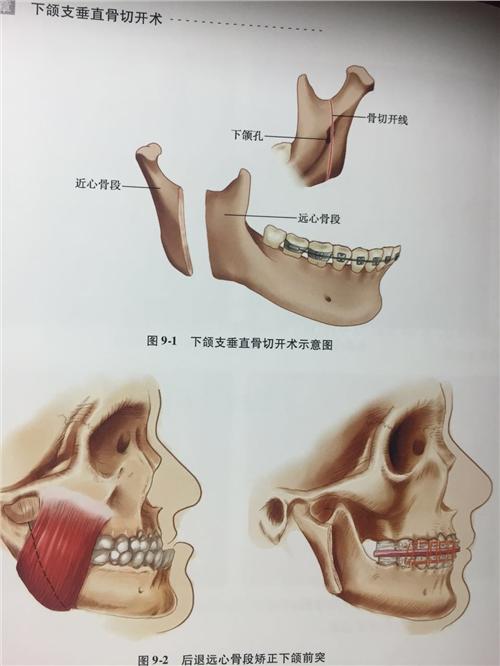 下頜升支矢狀截骨術