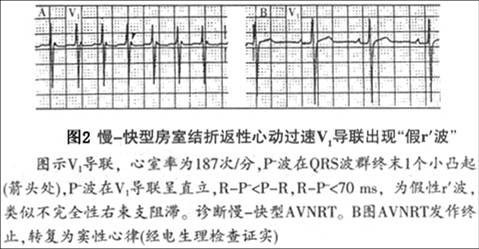 房室結雙徑路