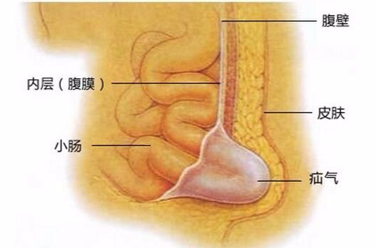 疝氣手術