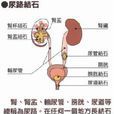 上尿路結石