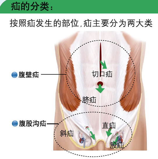 雜交式切口疝修補術