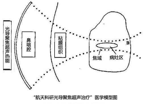 航天科研光導聚焦超聲治療體系