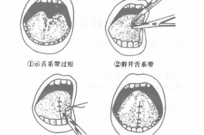 舌系帶矯正術