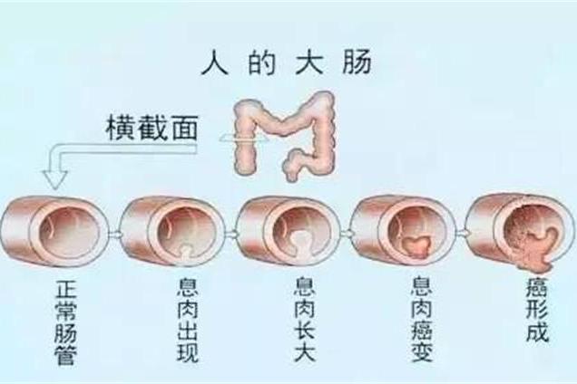 結直腸息肉病