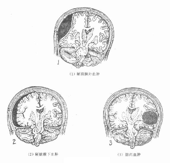 創傷性硬腦膜外血腫