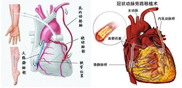 凹凸齒止血夾