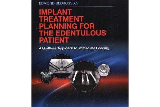 Implant Treatment Planning for the Edentulous Patient