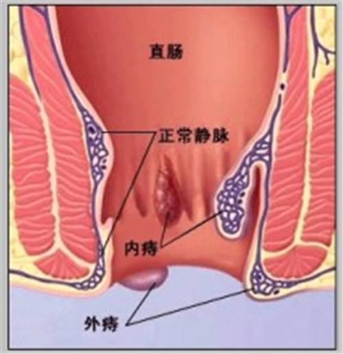 炎性外痔瘡