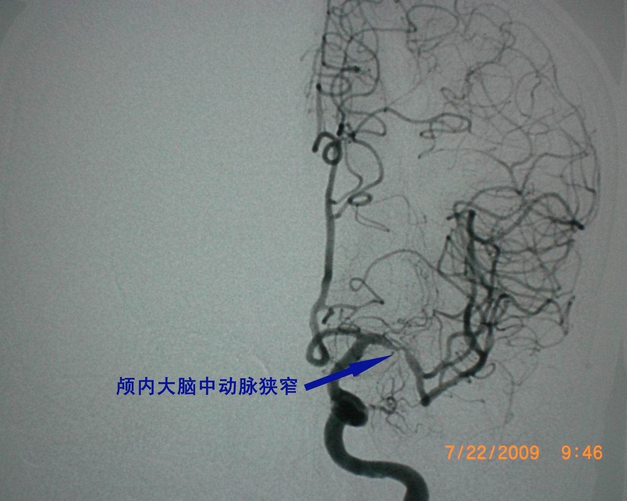 腦動脈痙攣