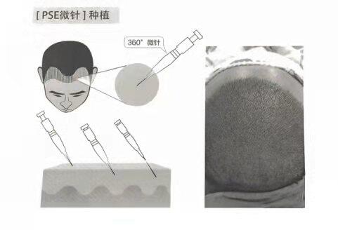 微針植髮
