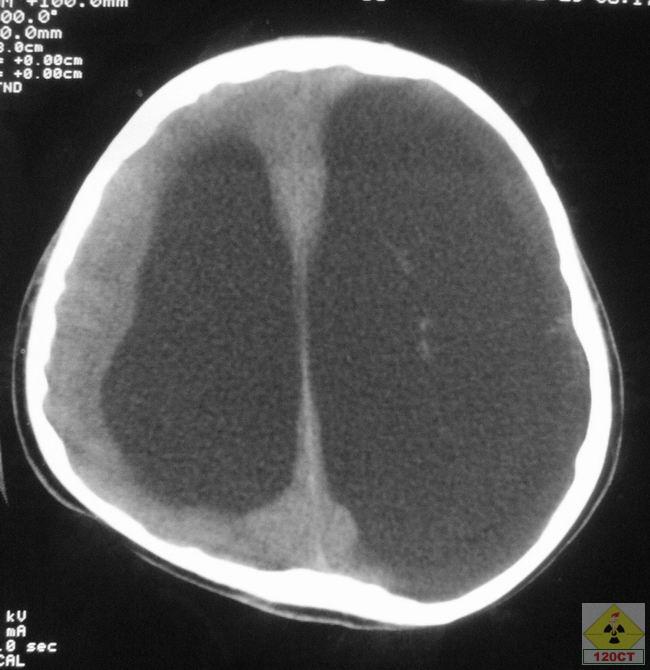 外部性腦積水