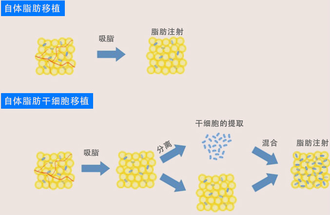 自體脂肪幹細胞移植