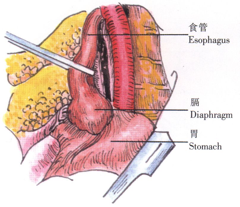 食管抗反流術