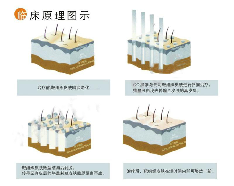 像素雷射除皺