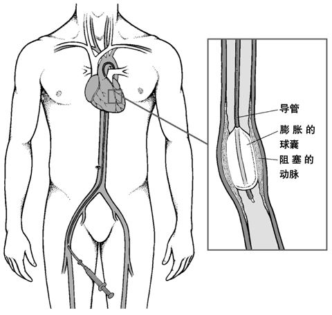 冠脈搭橋