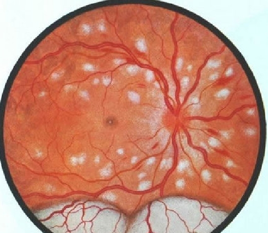 妊娠毒血症性視網膜病變