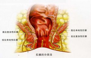 肛瘺病理圖