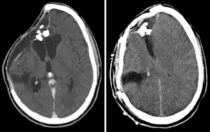 外傷性急性瀰漫性腦腫脹減壓術