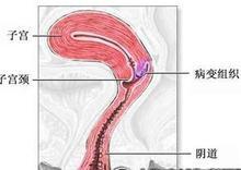 女性宮頸性不孕的症狀有哪些