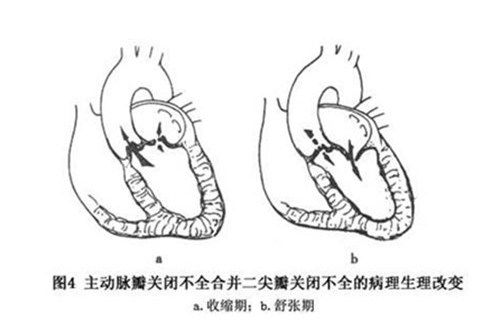 主動脈瓣閉鎖