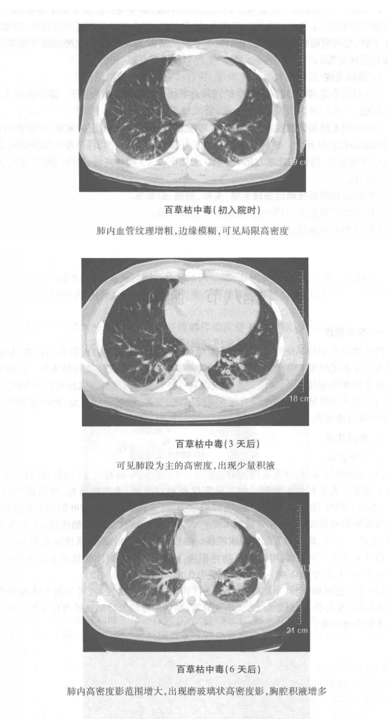 百草枯(百枯草)