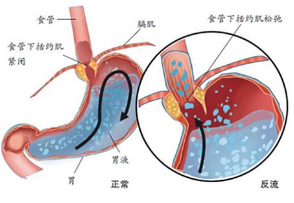 胃食道返流咳嗽