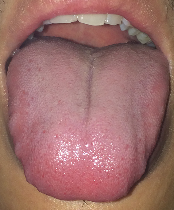 齒痕舌