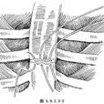 胸骨骨折內固定術