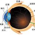 紡錘形白內障