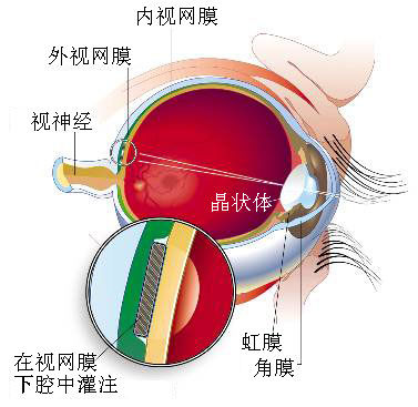 人工視力