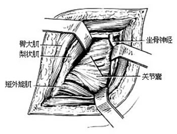 髖關節切開引流術