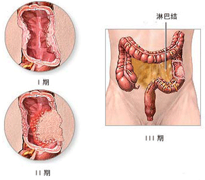 直腸惡變