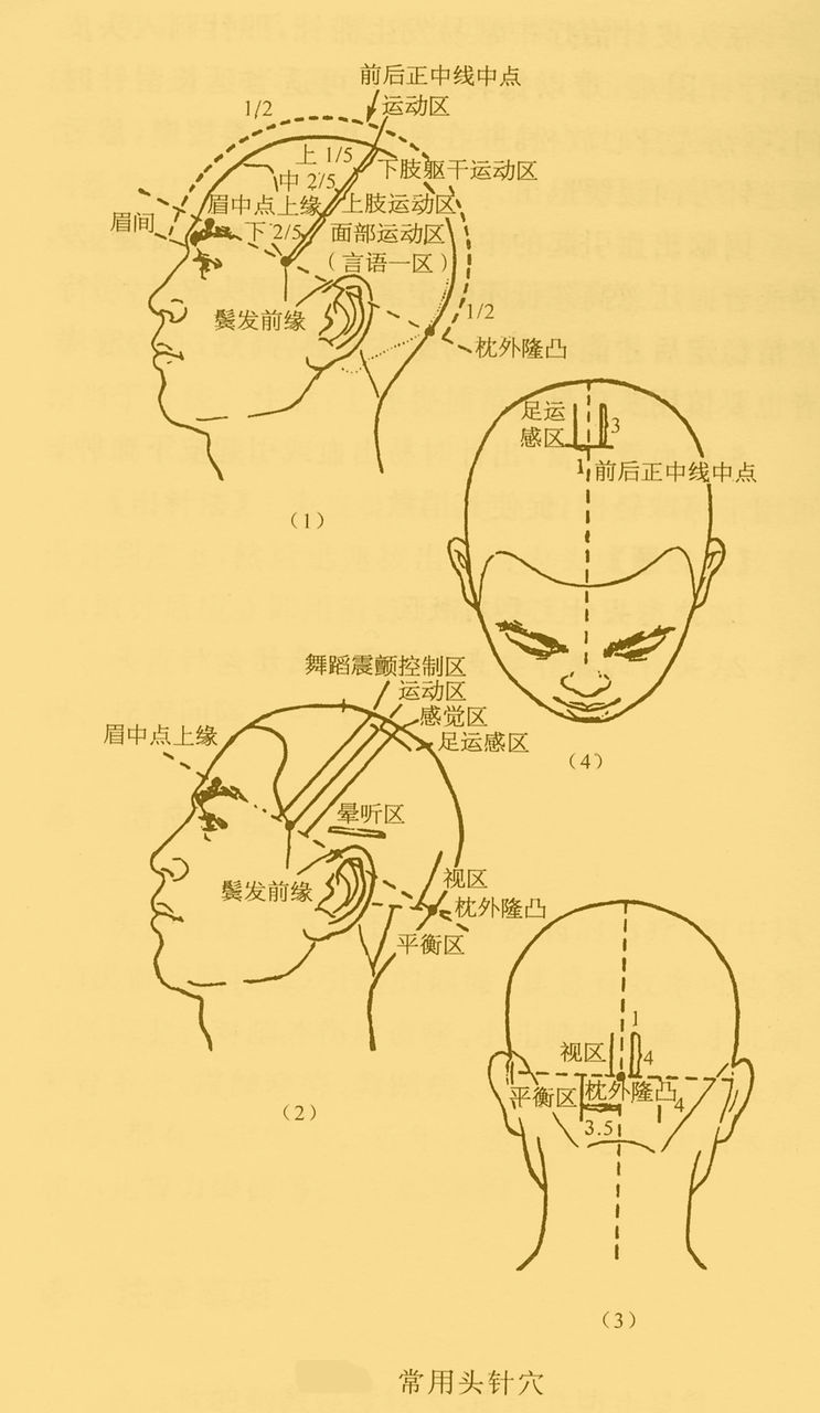 常用頭皮針刺激部點陣圖