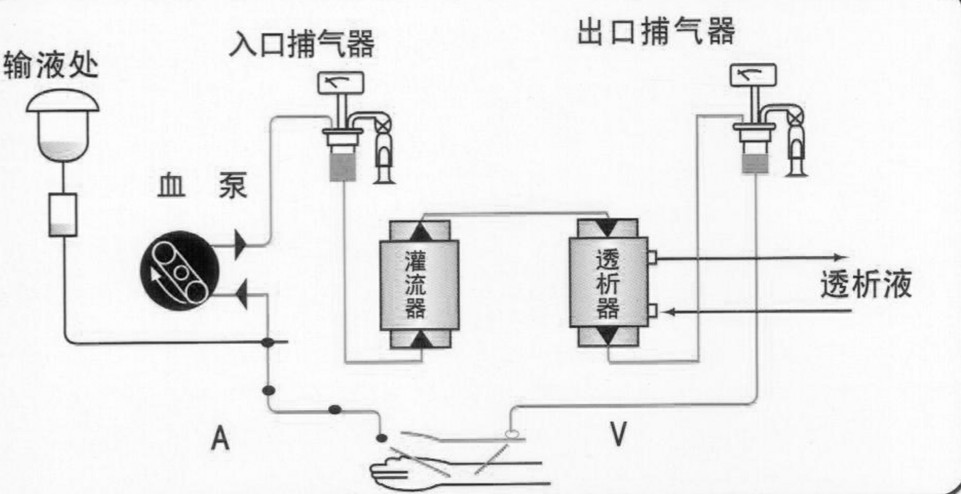 血液透析聯合血液灌流