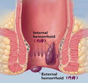 外痔