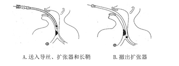 氣管支架